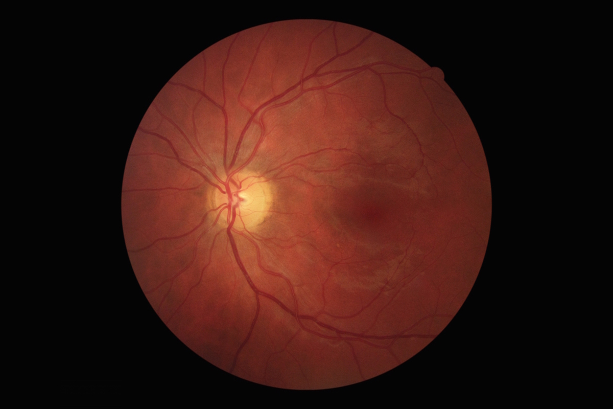 EyeQ Santa Cruz Eye Test Result